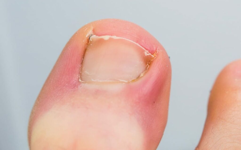 Ingrown Nail Cleaning (non-medical)